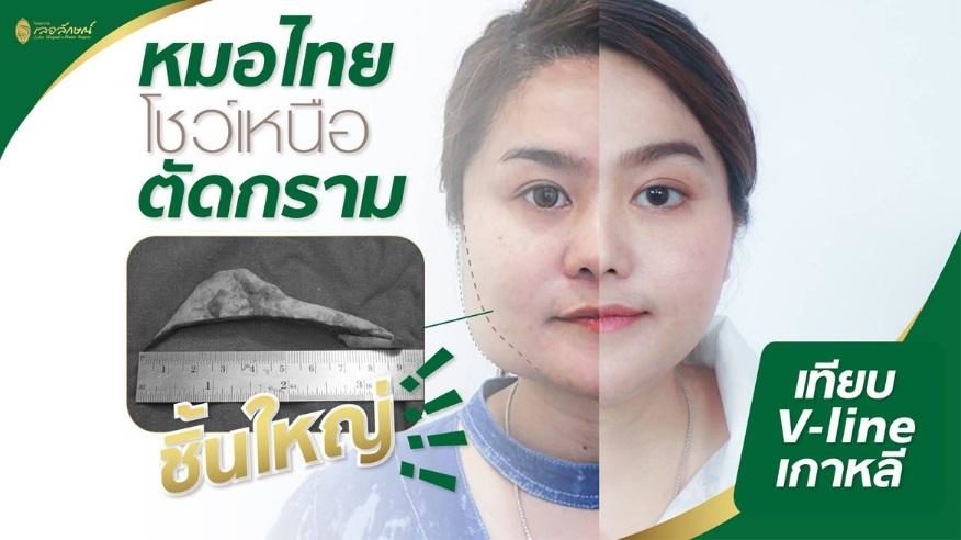 เลอลักษณ์” ให้คุณมั่นใจเต็มร้อย ด้วยการตัดกรามที่ “มากกว่า” เพื่อทุกโอกาสในชีวิต - ข่าวสด เลอลักษณ์” ให้คุณมั่นใจเต็มร้อย ด้วยการตัดกรามที่ “มากกว่า” เพื่อทุกโอกาสในชีวิต - ข่าวสด