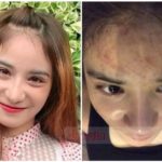 เน็ตไอดอลสาว ร้องปคบ. คลินิกเสริมสวย ทำหน้าพัง แฉพบสารอันตราย-ถูกอย.ค้น