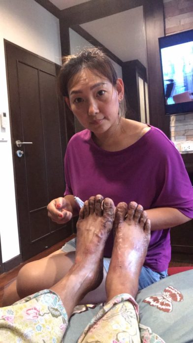 ตุ่มขึ้นอีกแล้ว! ตุ่มขึ้นอีกแล้ว!