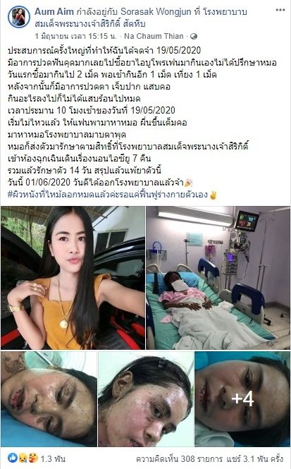 อุทาหรณ์ครั้งใหญ่ สาวปวดฟันคุด กินยาแพ้หนัก ผื่นทั้งตัว ผิวไหม้ เข้าไอซียู อุทาหรณ์ครั้งใหญ่ สาวปวดฟันคุด กินยาแพ้หนัก ผื่นทั้งตัว ผิวไหม้ เข้าไอซียู