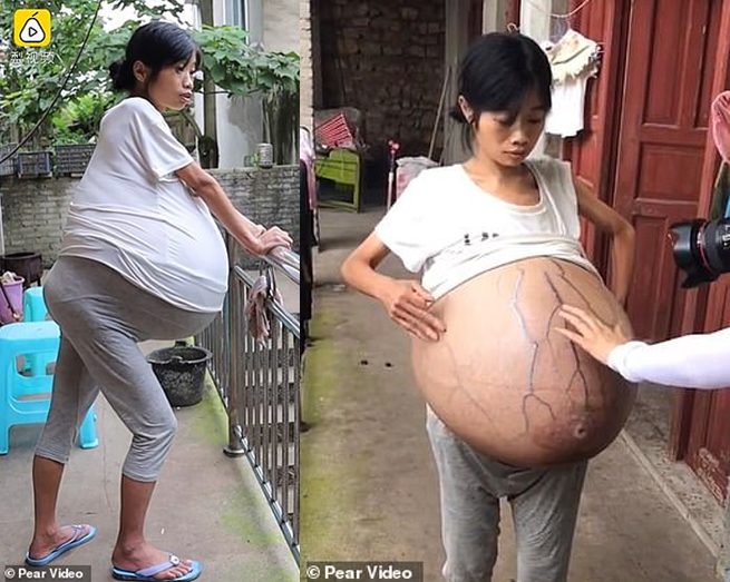 หญิงจีนท้องบวมเป่ง