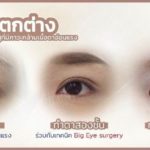 ล้วงลึก! ทำตาสองชั้นกับหมอหลิน inZ Clinic ด้วยเทคนิค “Big eye surgery”