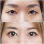 ล้วงลึก! ทำตาสองชั้นกับหมอหลิน inZ Clinic ด้วยเทคนิค “Big eye surgery”