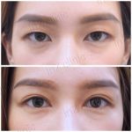 ล้วงลึก! ทำตาสองชั้นกับหมอหลิน inZ Clinic ด้วยเทคนิค “Big eye surgery”