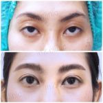 ล้วงลึก! ทำตาสองชั้นกับหมอหลิน inZ Clinic ด้วยเทคนิค “Big eye surgery”