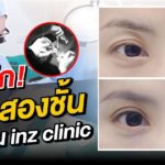 ล้วงลึก! ทำตาสองชั้นกับหมอหลิน inZ Clinic ด้วยเทคนิค “Big eye surgery”