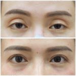 ล้วงลึก! ทำตาสองชั้นกับหมอหลิน inZ Clinic ด้วยเทคนิค “Big eye surgery”