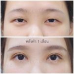 ล้วงลึก! ทำตาสองชั้นกับหมอหลิน inZ Clinic ด้วยเทคนิค “Big eye surgery”