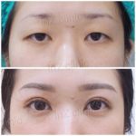 ล้วงลึก! ทำตาสองชั้นกับหมอหลิน inZ Clinic ด้วยเทคนิค “Big eye surgery”