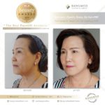 “New Modern Facelift 2021” บอกลาปัญหาเหี่ยวย่น ด้วย 3 เทคนิคศัลยกรรม เพื่อใบหน้าอ่อนเยาว์อย่างเป็นธรรมชาติ