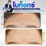 เสริมบุคลิกภาพให้ดูดี ด้วยการฉีดโบท็อก หนึ่งในนวัตกรรมความงามทางการแพทย์ มีข้อดีอย่างไร 