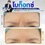 เสริมบุคลิกภาพให้ดูดี ด้วยการฉีดโบท็อก หนึ่งในนวัตกรรมความงามทางการแพทย์ มีข้อดีอย่างไร 