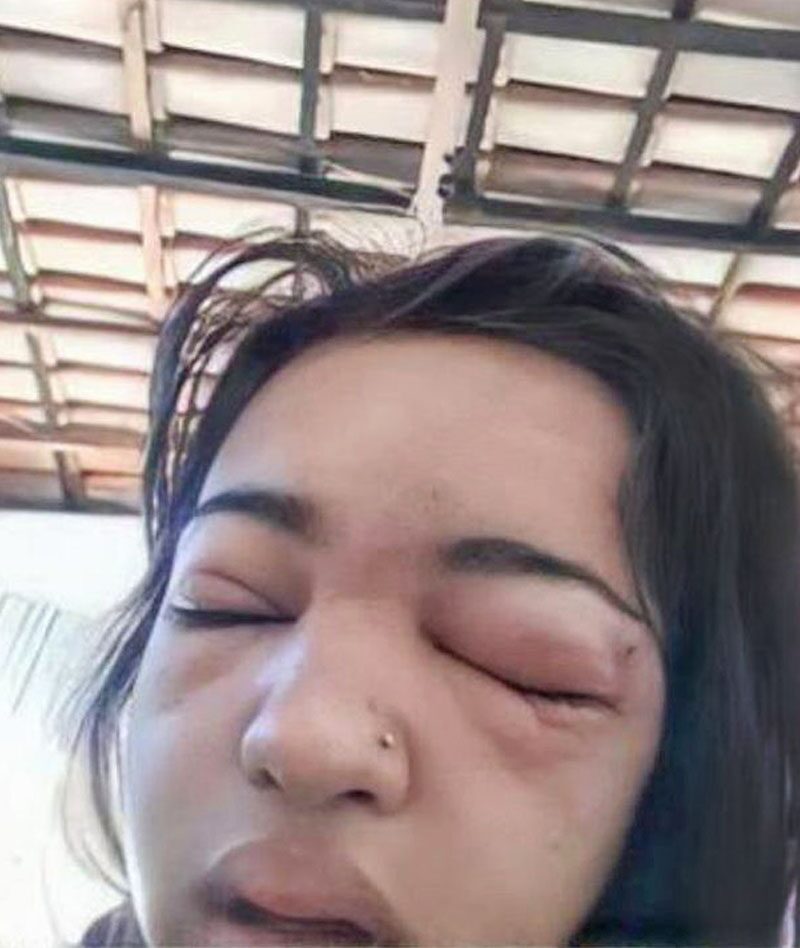 สาวบราซิล “เจาะคิ้วเอง”