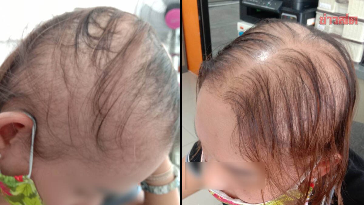 สสจ. ชี้ สาวฉีดแอสตร้าฯเข็ม 3 แล้วผมร่วง ต้องตรวจสอบ ว่าเกิดจากวัคซีนหรือไม่
