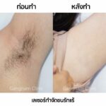 เลเซอร์ขนรักแร้ กำจัดขนหายจริง ทำแล้วไม่เจ็บ ต้องเครื่องเลเซอร์แบบไหนถึงจะดี