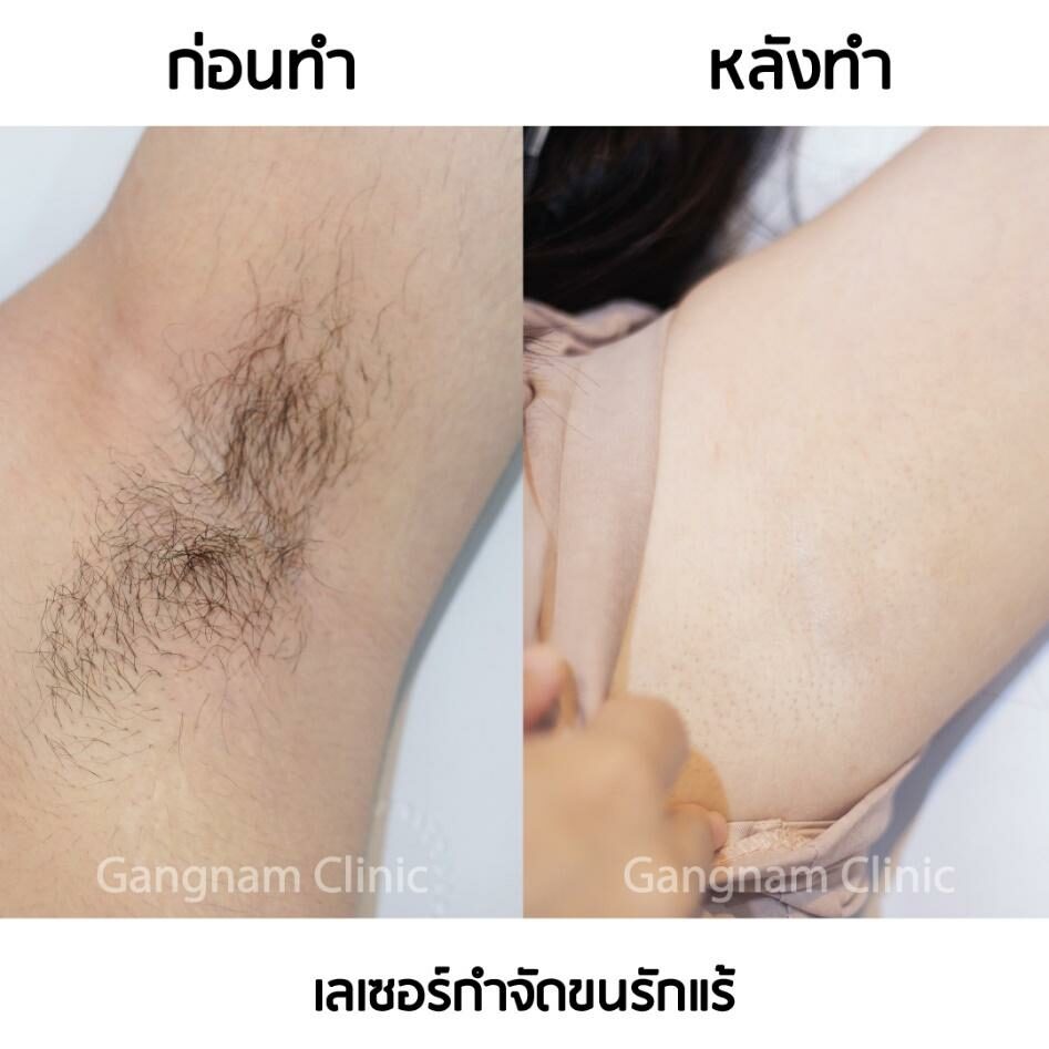 เลเซอร์ขนรักแร้ กำจัดขนหายจริง ทำแล้วไม่เจ็บ ต้องเครื่องเลเซอร์แบบไหนถึงจะดี - ข่าวสด เลเซอร์ขนรักแร้ กำจัดขนหายจริง ทำแล้วไม่เจ็บ ต้องเครื่องเลเซอร์แบบไหนถึงจะดี - ข่าวสด