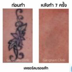 ก่อนเลเซอร์ลบรอยสักควรรู้อะไร? ทำกี่ครั้งเห็นผล? ใครบ้างที่เหมาะกับวิธีนี้?