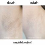 เลเซอร์ขนรักแร้ กำจัดขนหายจริง ทำแล้วไม่เจ็บ ต้องเครื่องเลเซอร์แบบไหนถึงจะดี