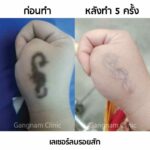 ก่อนเลเซอร์ลบรอยสักควรรู้อะไร? ทำกี่ครั้งเห็นผล? ใครบ้างที่เหมาะกับวิธีนี้?
