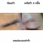 ก่อนเลเซอร์ลบรอยสักควรรู้อะไร? ทำกี่ครั้งเห็นผล? ใครบ้างที่เหมาะกับวิธีนี้?