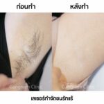 เลเซอร์ขนรักแร้ กำจัดขนหายจริง ทำแล้วไม่เจ็บ ต้องเครื่องเลเซอร์แบบไหนถึงจะดี
