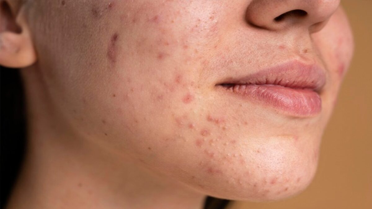 Dermatologist reveals 9 ways to treat acne scars Suitable according to