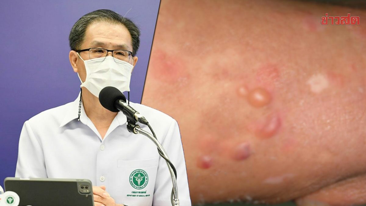 หมอ ชี้ โรคตุ่มน้ำพองใส เกิดได้หลังฉีดวัคซีนโควิด ย้ำ รักษาให้หายได้