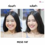 ฉีดเมโสแฟต ทำให้หน้าเรียวจริงไหม? อยากฉีดแฟตให้ได้ผลและปลอดภัยควรรู้