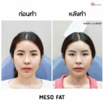 ฉีดเมโสแฟต ทำให้หน้าเรียวจริงไหม? อยากฉีดแฟตให้ได้ผลและปลอดภัยควรรู้