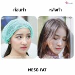 ฉีดเมโสแฟต ทำให้หน้าเรียวจริงไหม? อยากฉีดแฟตให้ได้ผลและปลอดภัยควรรู้