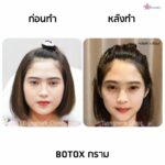 โบท็อกกรามหน้าเรียวเห็นผลจริงมั้ย? พร้อมแนะนำข้อควรรู้วิธีเช็คของแท้-ปลอม ก่อนฉีดโบลดกราม