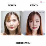 โบท็อกกรามหน้าเรียวเห็นผลจริงมั้ย? พร้อมแนะนำข้อควรรู้วิธีเช็คของแท้-ปลอม ก่อนฉีดโบลดกราม