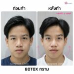 โบท็อกกรามหน้าเรียวเห็นผลจริงมั้ย? พร้อมแนะนำข้อควรรู้วิธีเช็คของแท้-ปลอม ก่อนฉีดโบลดกราม