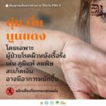 4 สัญญาณเตือนจากร่างกาย ให้ระวังฝุ่น PM 2.5