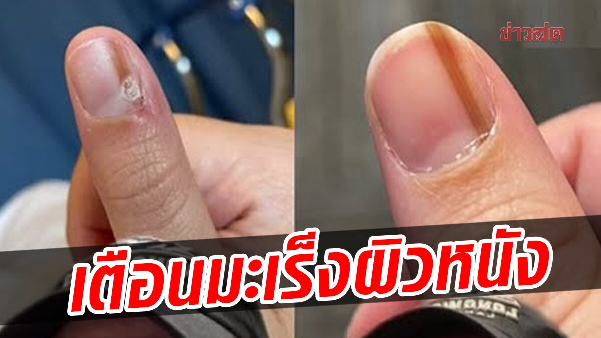 Doctors point out brown or black streaks on nails, warning signs of