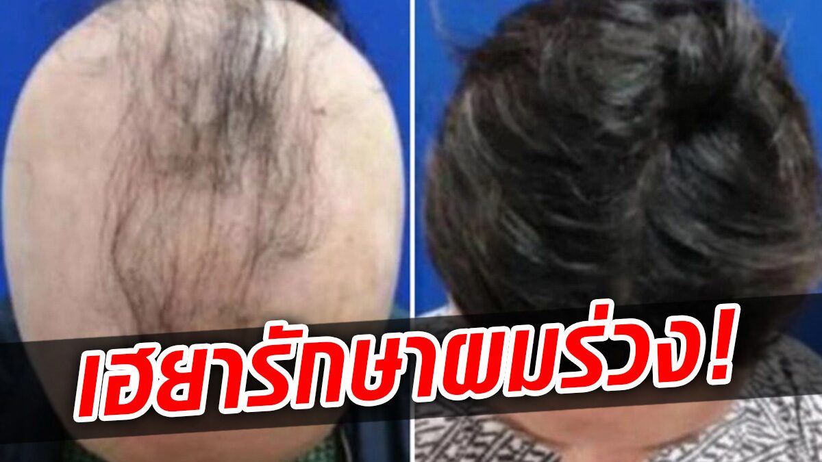 Scientist Hellen The first drug for hair loss is better than expected – full head in 6 months – fresh news - Time News Scientist Hellen The first drug for hair loss is better than expected – full head in 6 months – fresh news - Time News