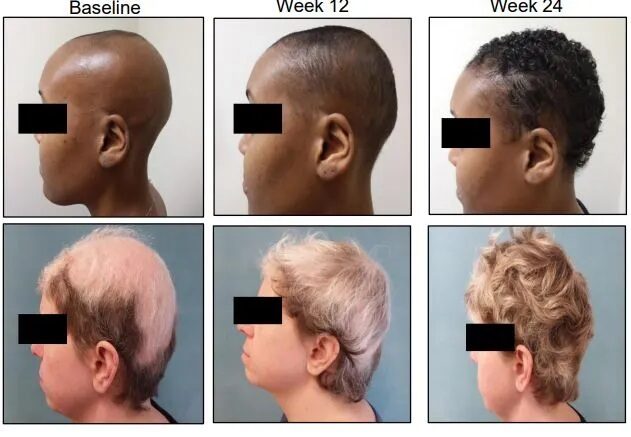 Scientist Hellen The first drug for hair loss is better than expected – full head in 6 months – fresh news - Time News Scientist Hellen The first drug for hair loss is better than expected – full head in 6 months – fresh news - Time News