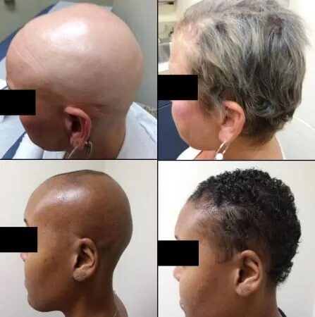 Scientist Hellen The first drug for hair loss is better than expected – full head in 6 months – fresh news - Time News Scientist Hellen The first drug for hair loss is better than expected – full head in 6 months – fresh news - Time News
