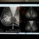 บำรุงราษฎร์ เปิดตัว Radiology AI ปัญญาประดิษฐ์ทางรังสีวิทยา