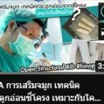 เทรนด์ศัลยกรรมจมูก ปี 2022 ด้วยวิธีใช้กระดูกซี่โครงตัวเอง