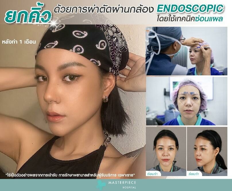 การดึงหน้า ยกคิ้ว
