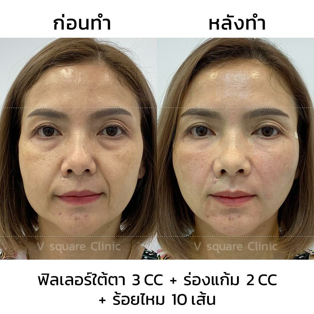 รีวิวฟิลเลอร์ใต้ตา2
