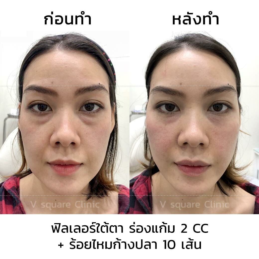 รีวิวฟิลเลอร์ใต้ตา1