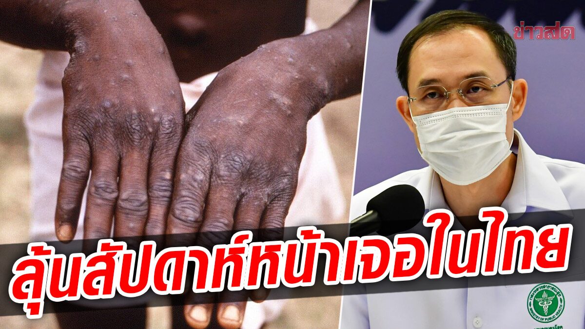 ระทึกเลย! คาดสัปดาห์หน้าเจอแน่ ป่วยฝีดาษลิงในไทย จากงาน 'ไพรด์พาเหรด' ที่ กทม.