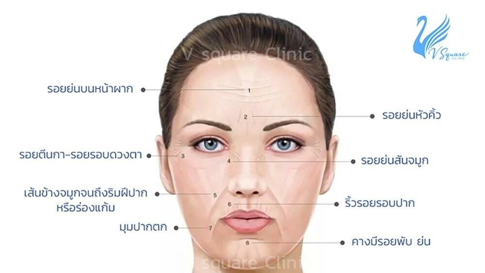 จุดฉีดโบท็อก