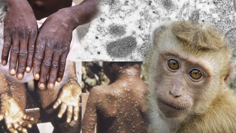 บทบรรณาธิการ – เฝ้าระวังโรคฝีดาษลิง