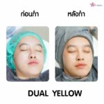 เลเซอร์หน้าใส Dual yellow ควรทำกี่ครั้ง อยากมีผิวหน้าสุขภาพดีต้องอ่าน