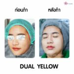 เลเซอร์หน้าใส Dual yellow ควรทำกี่ครั้ง อยากมีผิวหน้าสุขภาพดีต้องอ่าน