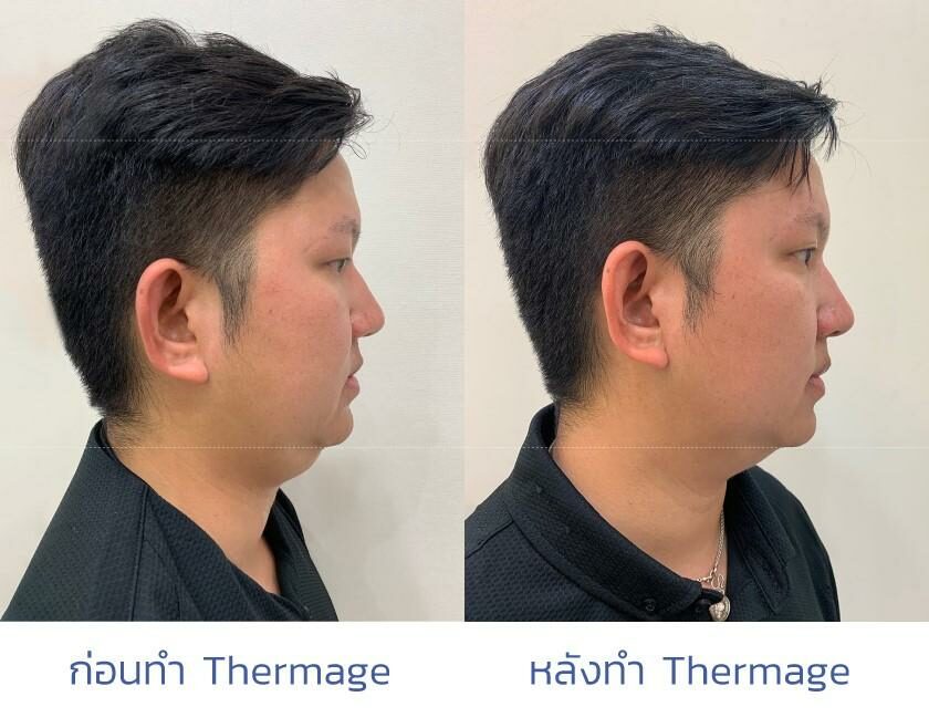 รีวิวการทำ Thermage FLX ยกกระชับผิว