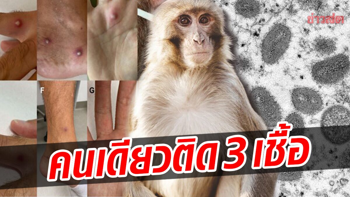 รายแรกของโลก! ผู้ป่วยอิตาลี ติดเชื้อฝีดาษลิง-โควิด-HIV พร้อมกัน หลังร่วมรักไม่ป้องกัน